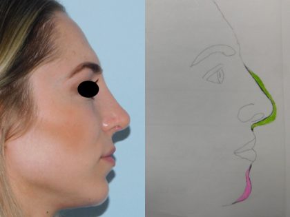 Rhinoplasty Before & After Patient #3066