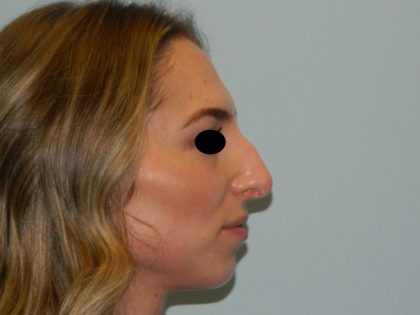 Rhinoplasty Before & After Patient #3066