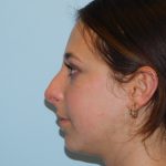Rhinoplasty Before & After Patient #3036