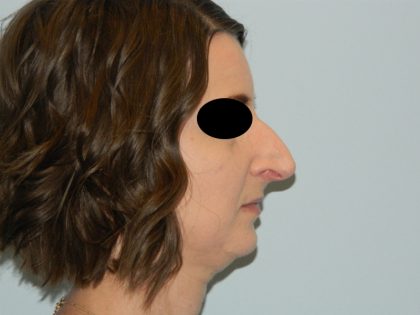 Rhinoplasty Before & After Patient #2992