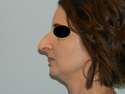 Rhinoplasty Before & After Patient #2992