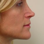 Rhinoplasty Before & After Patient #2990