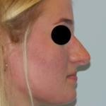 Rhinoplasty Before & After Patient #2988