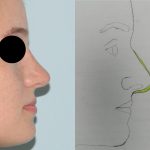 Rhinoplasty Before & After Patient #2988
