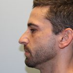 Rhinoplasty Before & After Patient #2987