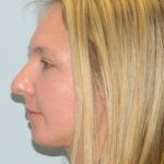 Rhinoplasty Before & After Patient #2986