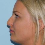 Rhinoplasty Before & After Patient #2985