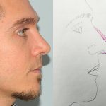 Rhinoplasty Before & After Patient #3065