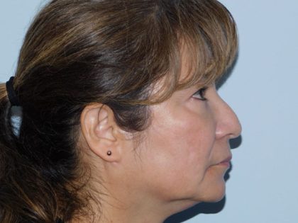 Rhinoplasty Before & After Patient #2946