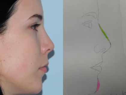 Rhinoplasty Before & After Patient #2945