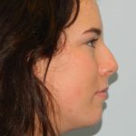 Rhinoplasty Before & After Patient #2945