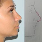 Rhinoplasty Before & After Patient #2944