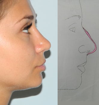 Rhinoplasty Before & After Patient #2944