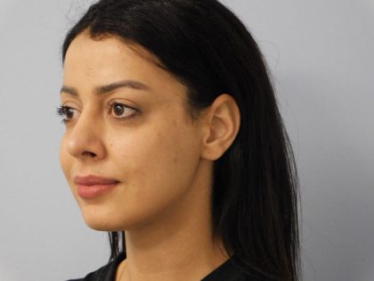 Rhinoplasty Before & After Patient #2943