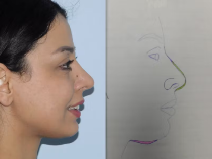 Rhinoplasty Before & After Patient #2943
