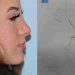 Rhinoplasty Before & After Patient #2941