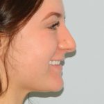 Rhinoplasty Before & After Patient #2941