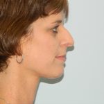 Rhinoplasty Before & After Patient #2938