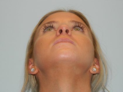 Rhinoplasty Before & After Patient #2937
