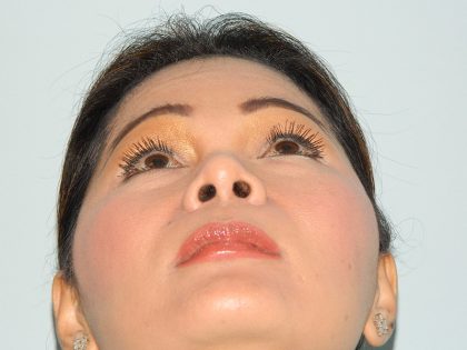 Rhinoplasty Before & After Patient #2875