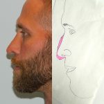 Rhinoplasty Before & After Patient #2874