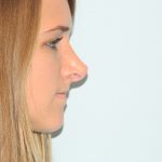 Rhinoplasty Before & After Patient #2873