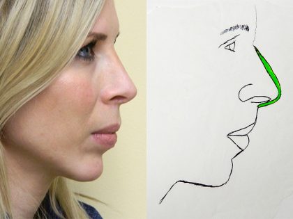 Rhinoplasty Before & After Patient #2872