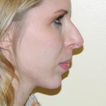 Rhinoplasty Before & After Patient #2872