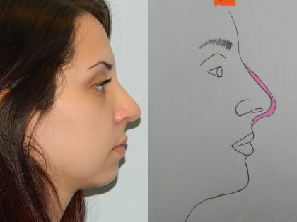 Rhinoplasty Before & After Patient #2870