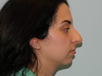 Rhinoplasty Before & After Patient #2870
