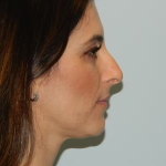 Rhinoplasty Before & After Patient #2869