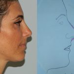 Rhinoplasty Before & After Patient #2869