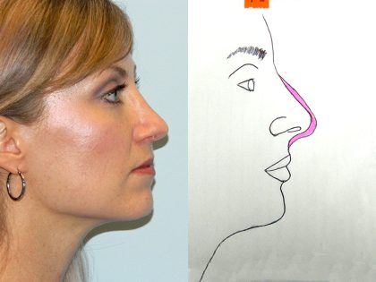 Rhinoplasty Before & After Patient #2867