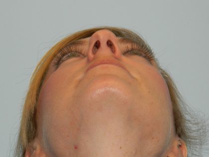 Rhinoplasty Before & After Patient #2867