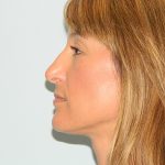 Rhinoplasty Before & After Patient #2866