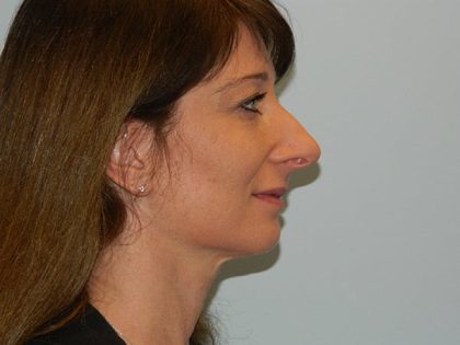 Rhinoplasty Before & After Patient #3063