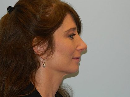 Rhinoplasty Before & After Patient #3063