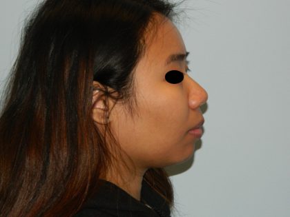 Rhinoplasty Before & After Patient #2716