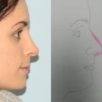 Rhinoplasty Before & After Patient #2714
