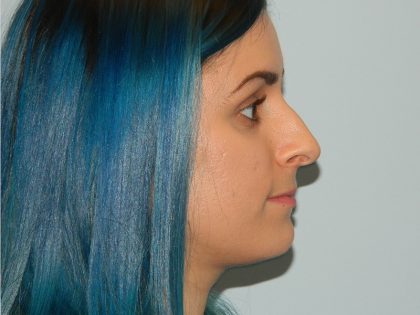 Rhinoplasty Before & After Patient #2714
