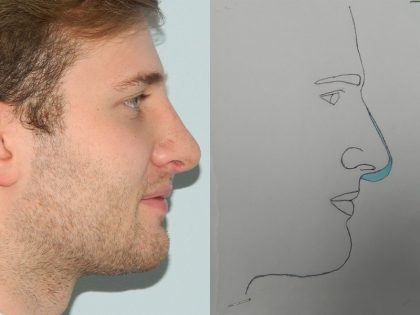 Rhinoplasty Before & After Patient #2713