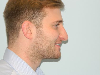 Rhinoplasty Before & After Patient #2713