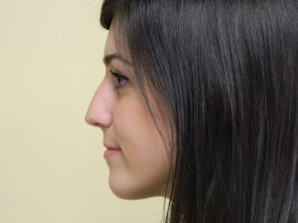 Rhinoplasty Before & After Patient #2712