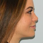 Rhinoplasty Before & After Patient #2711