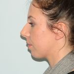 Rhinoplasty Before & After Patient #2710