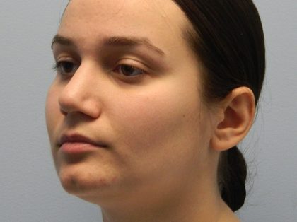 Rhinoplasty Before & After Patient #2709