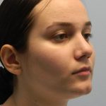 Rhinoplasty Before & After Patient #2709