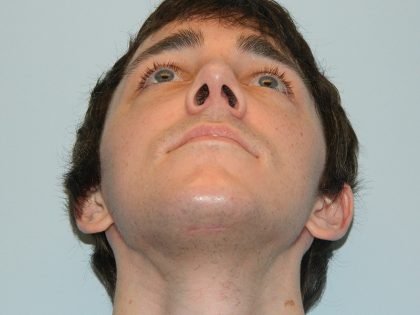 Rhinoplasty Before & After Patient #2707
