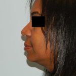 Rhinoplasty Before & After Patient #2705
