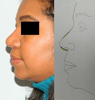 Rhinoplasty Before & After Patient #2705
